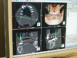 歯科用CT撮影装置（ヨシダ社製、ファインキューブ）