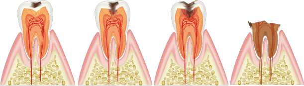 虫歯のステージ